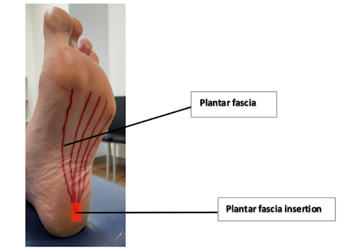 What to Do About Plantar Fasciitis Pain | Board Certified Foot and Ankle  Surgeon located in Grand Rapids and Bigfork, MN | Renew Foot & Ankle: Eric  Gilbertson, DPM, FACFAS